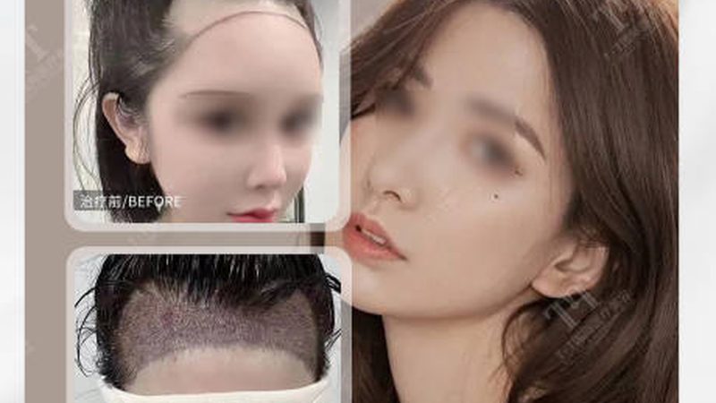 小标题：激光祛斑后注意事项