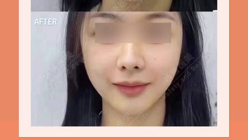割双眼皮后化妆上学，恢复期需知