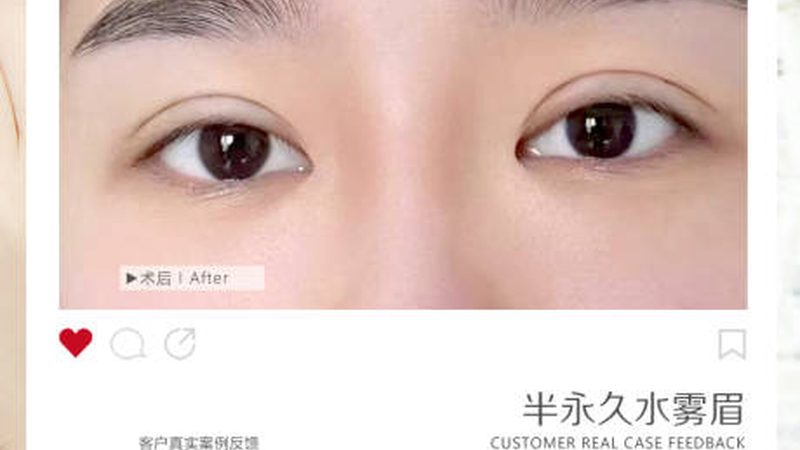 埋线提升，如何选择正规医院与合理价格？**