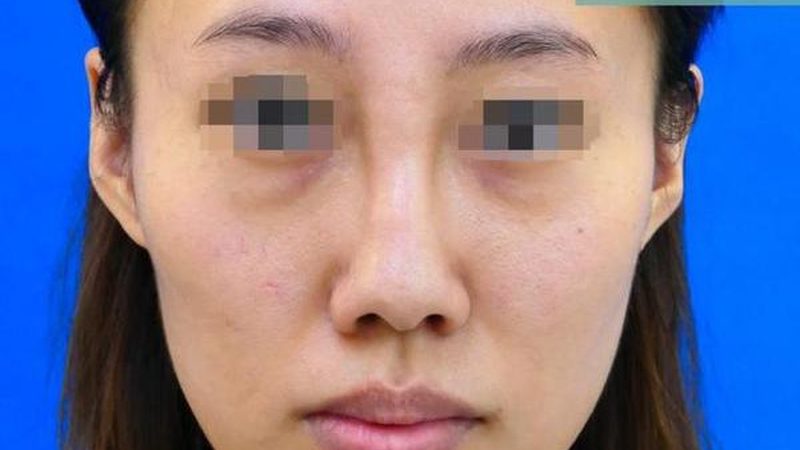 玻尿酸代理加盟，如何规避这些常见误区？**